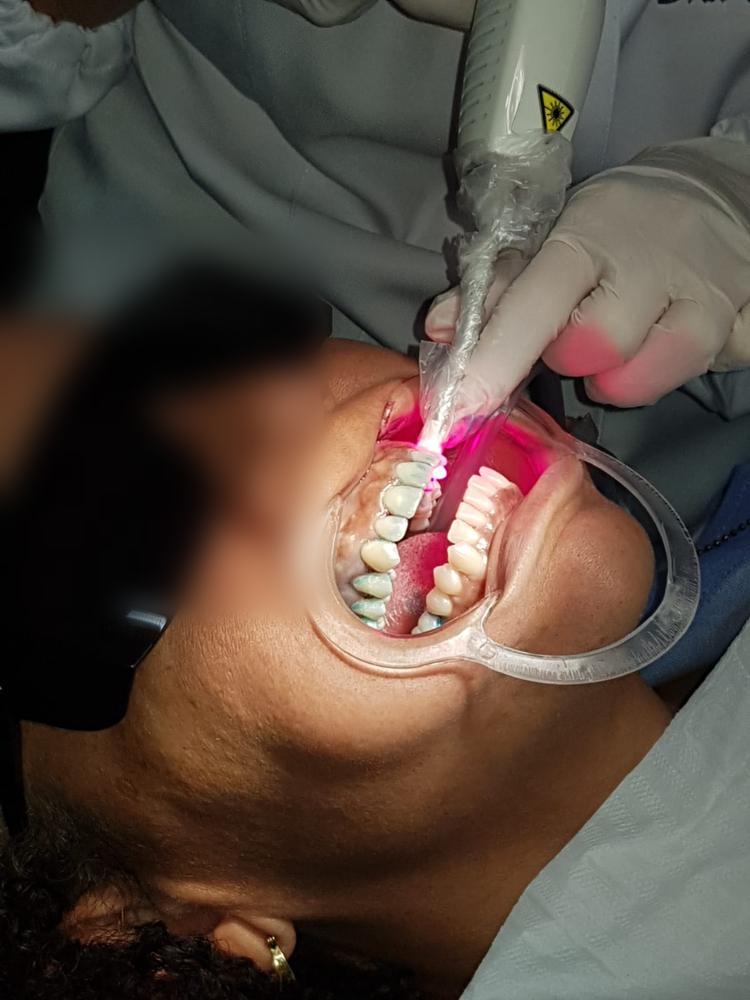 Terapia fotodinâmica na doença periodontal
